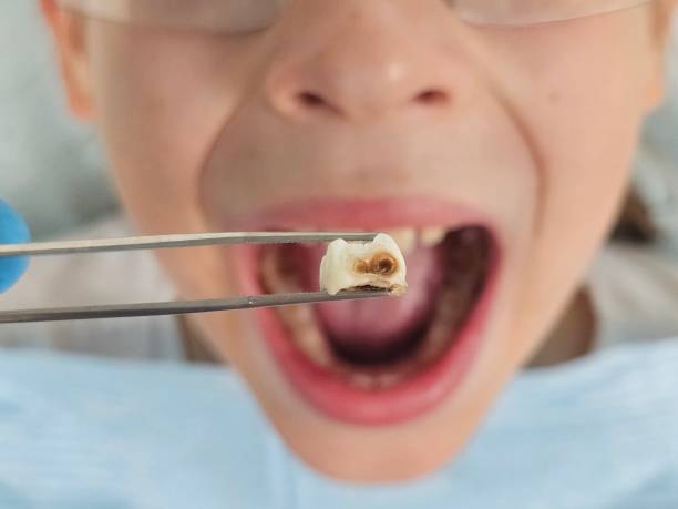 Best Knocked-Out Tooth (Avulsed Tooth) Treatment in Fayetteville, AL